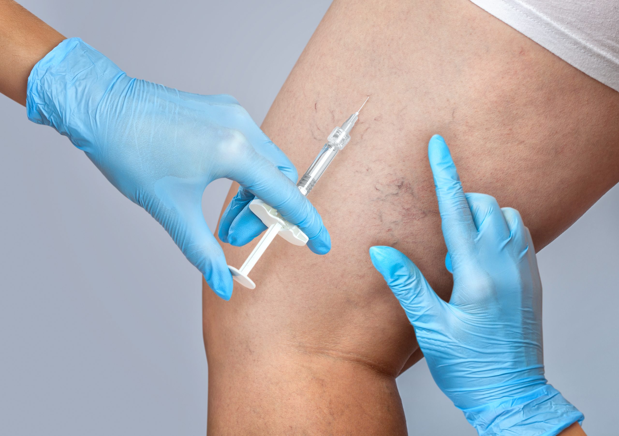 Escleroterapia
