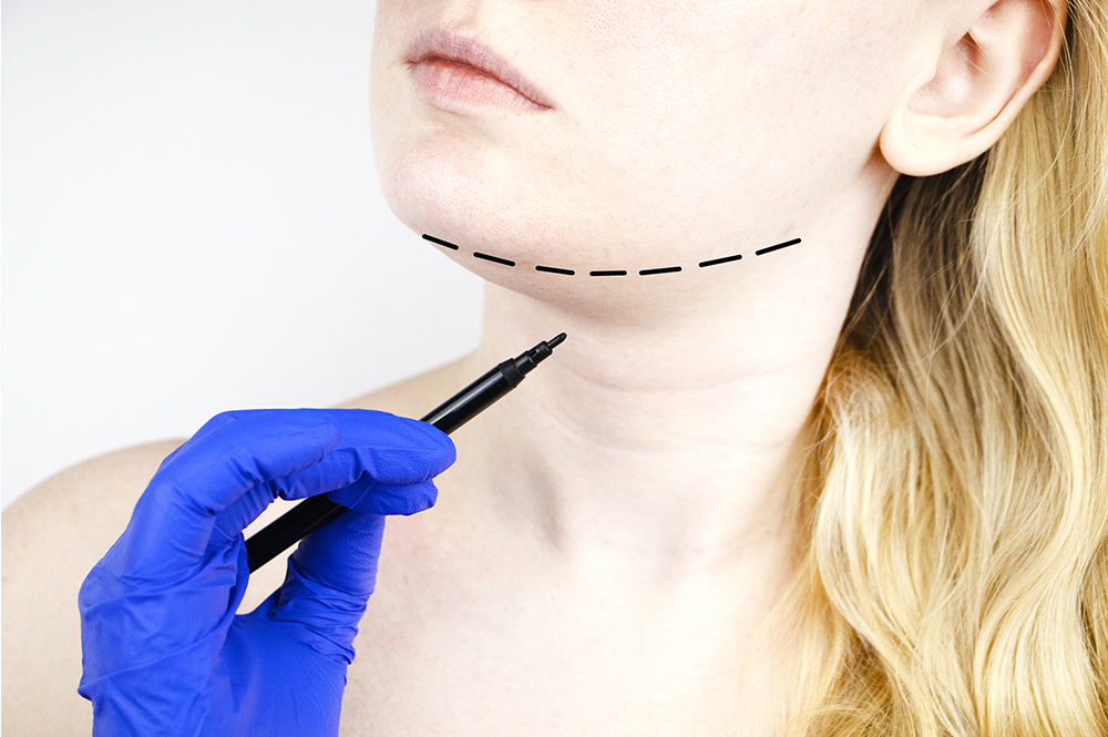 Mentoplastia