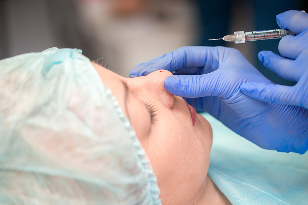 Rinoplastia