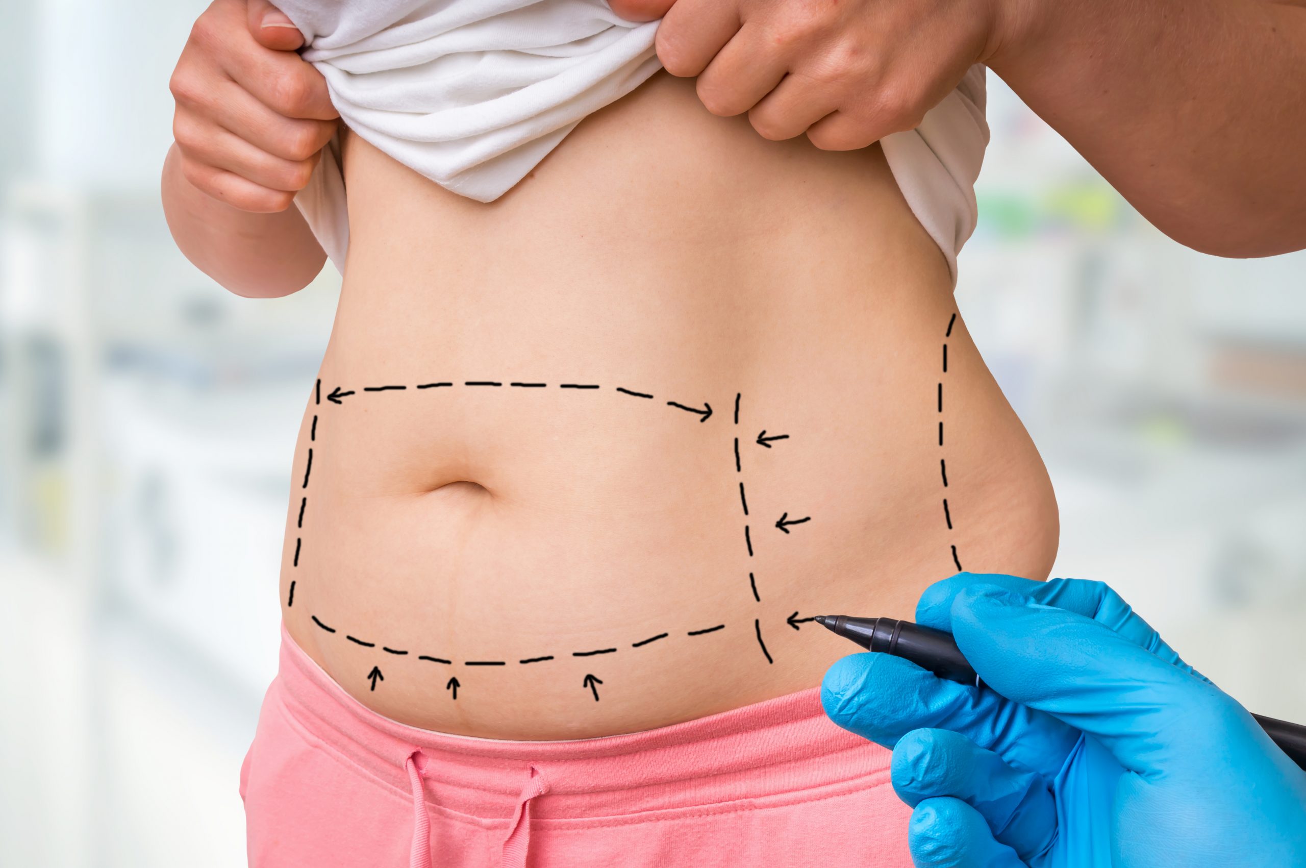 abdominoplastia